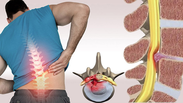Thoát vị đĩa đệm - Một trong những nguyên nhân gây ho đau lưng ít người biết
